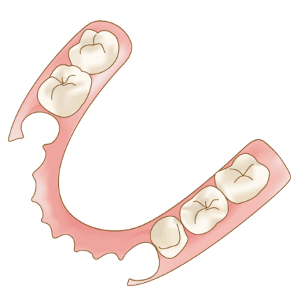 ノンクラスプデンチャー(自費)