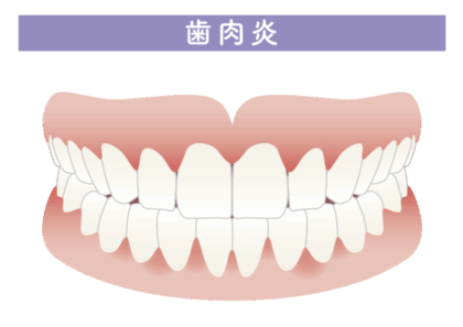 歯肉炎とは