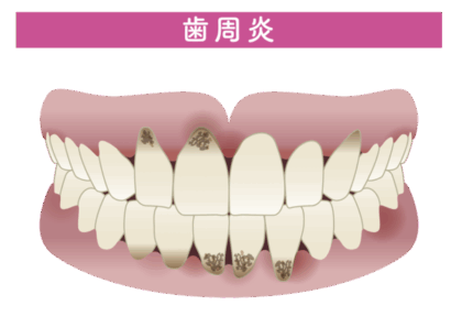 歯周炎とは