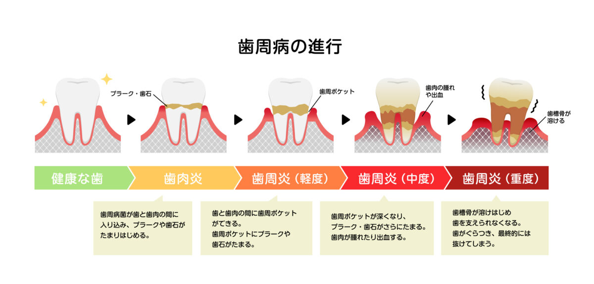 歯周病の主な進行について