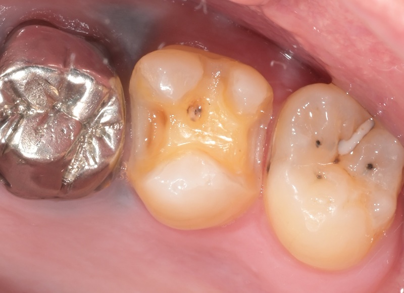 セラミックインレーによる虫歯の再治療症例